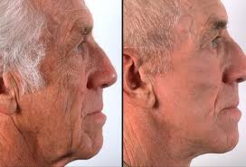 cosmetic surgery results